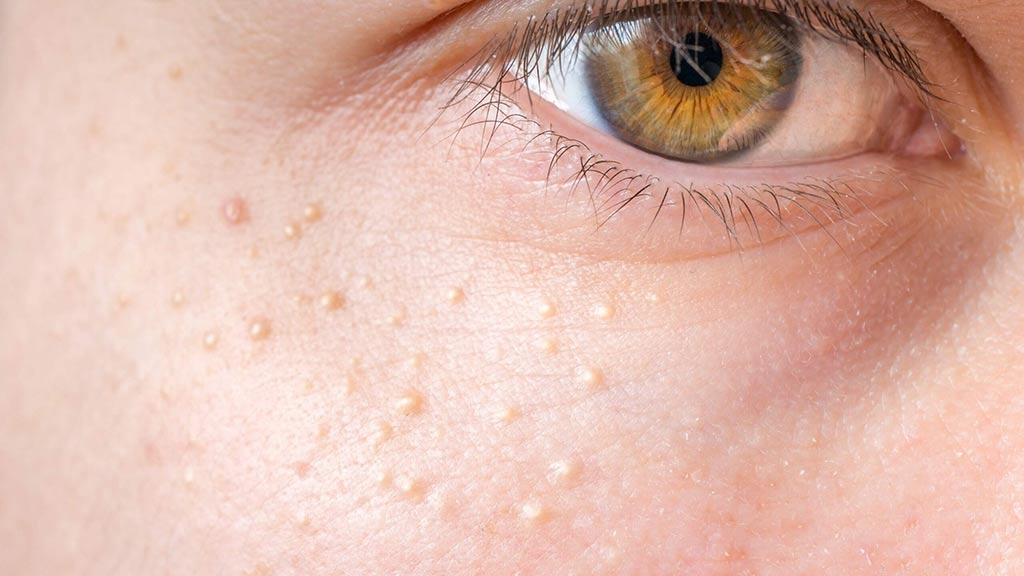 Skin Congestion Treatments