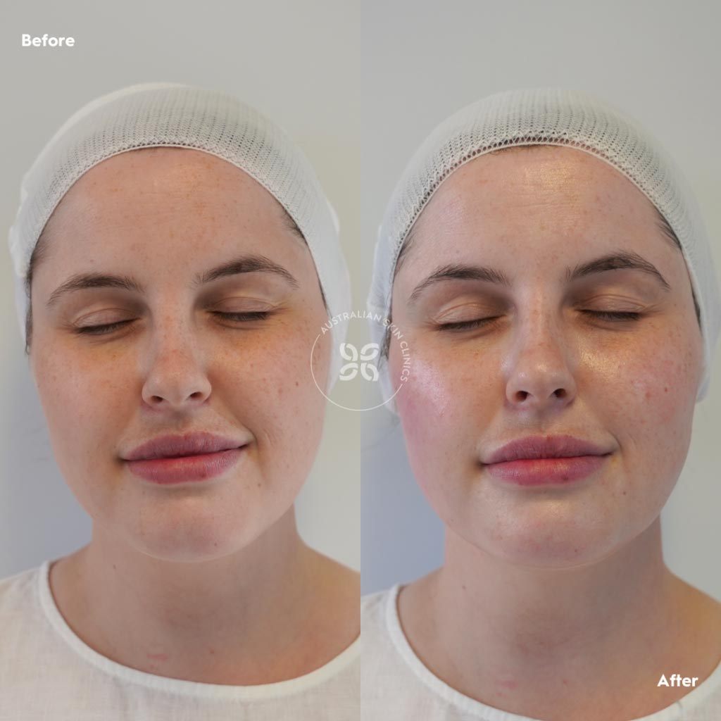 Dermaplanning Skin Treatments