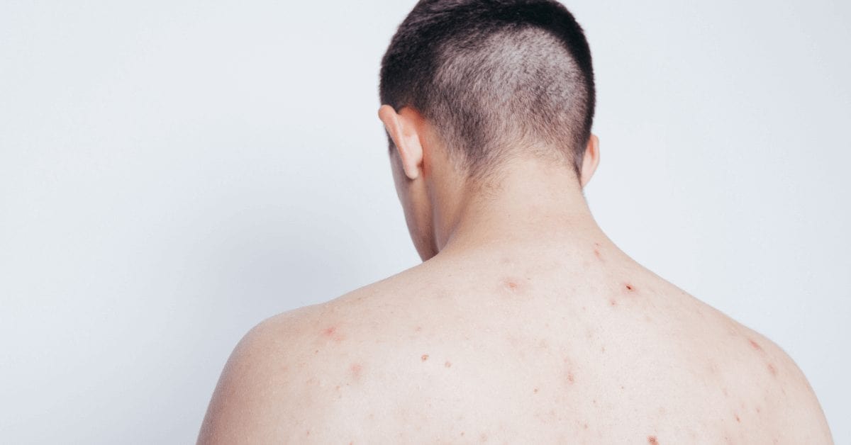 Back acne