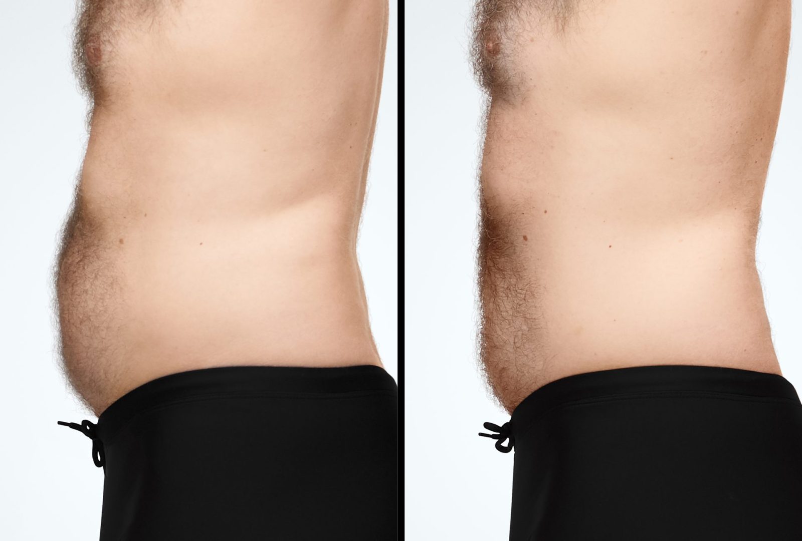 Coolsculpting Stubborn Fat Treatment