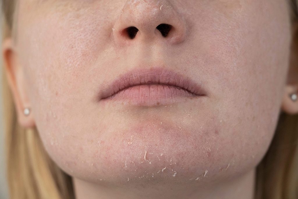 Sensitive Skin Treatments - Dehydrated Skin
