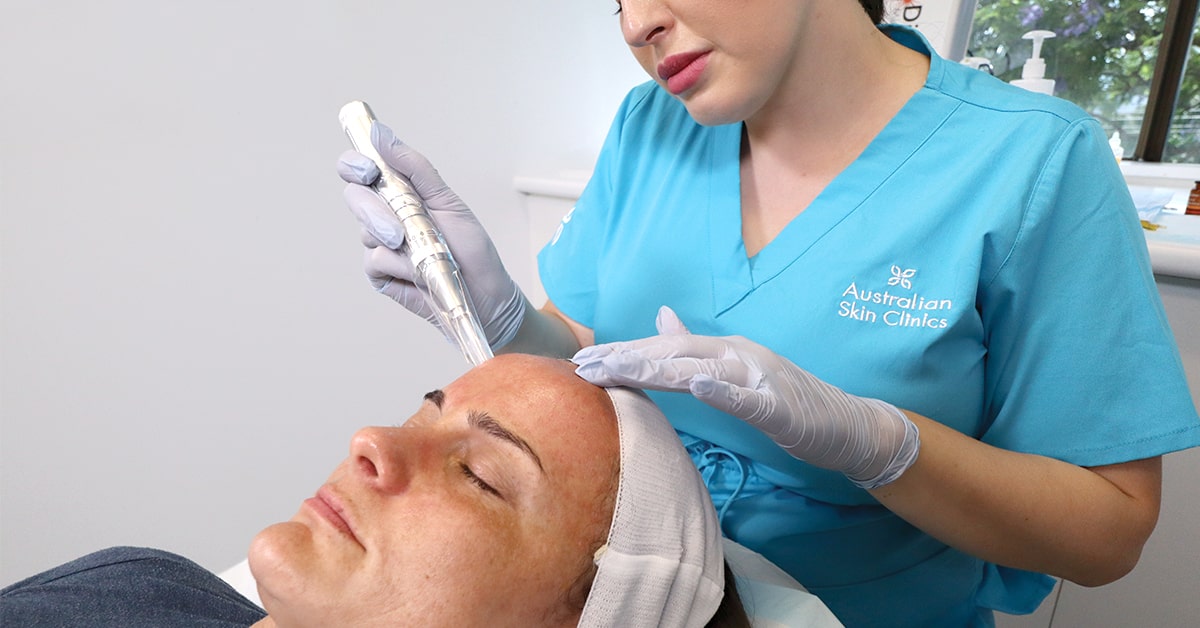 Meso-needling vs micro-needling