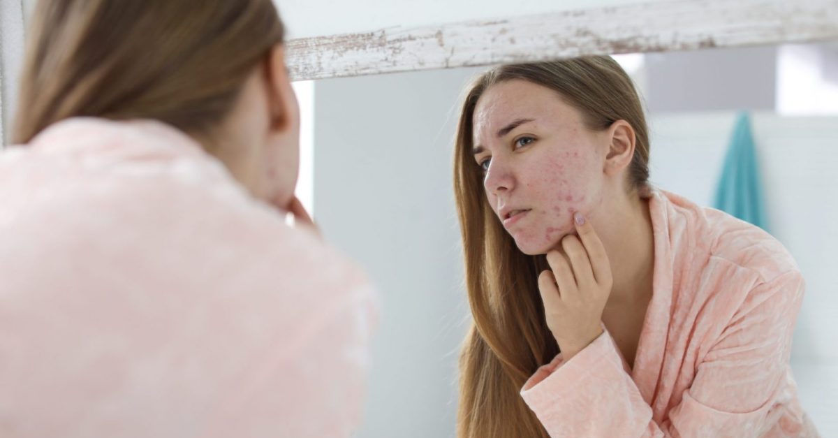 Guide to Acne