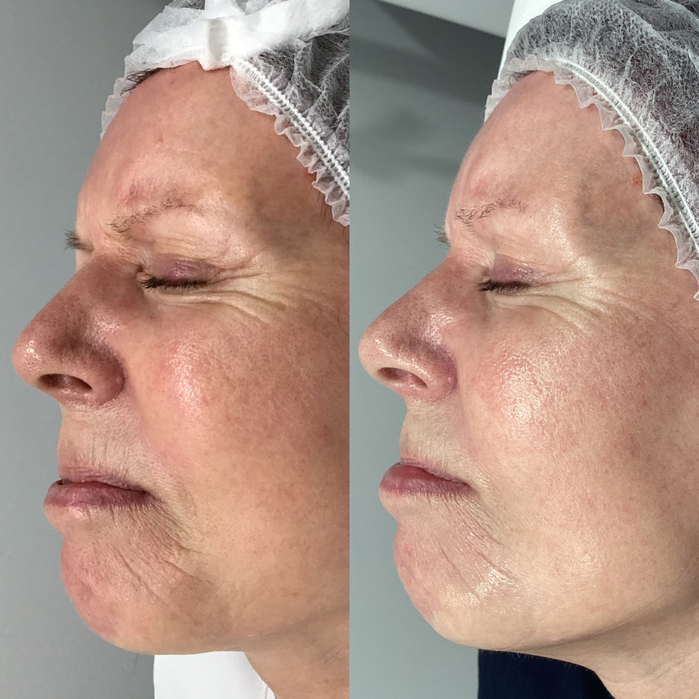 Renuva B&A