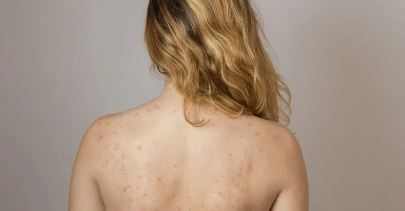 Acne Scarring and How to Treat It-min